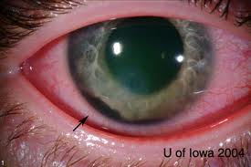 Eye Injury Lawyers and Lawsuits