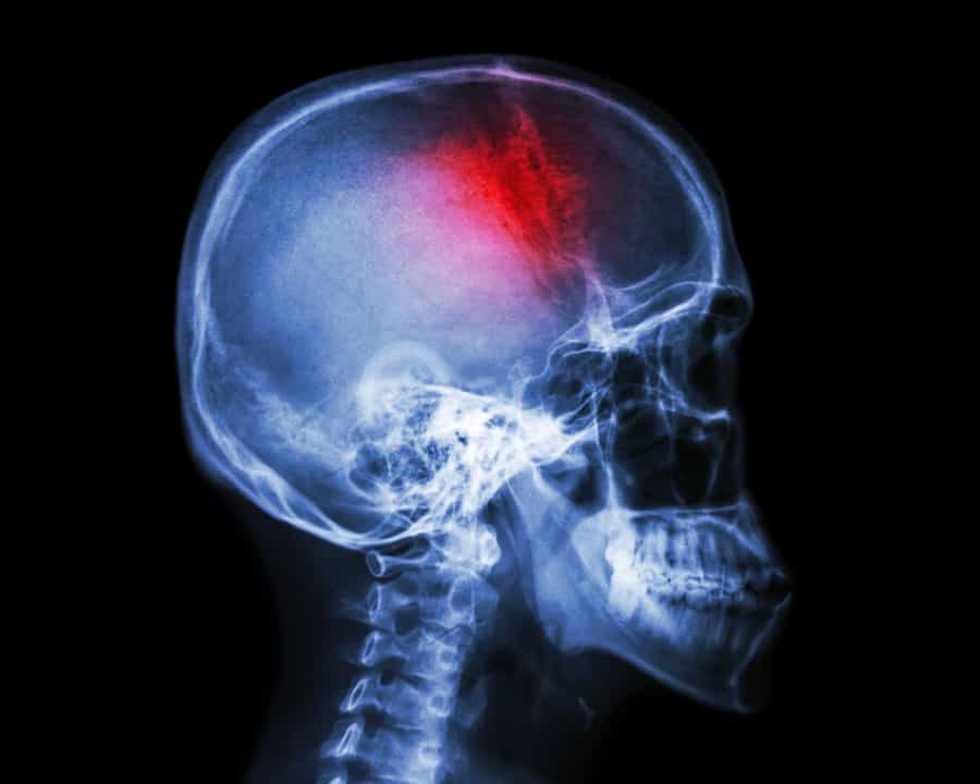 Traumatic Brain Injury Claims: What Victims Need to Know